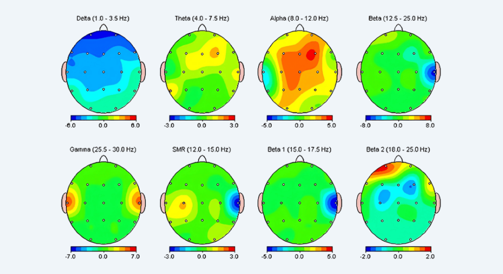 Neurofeedback Therapy #7